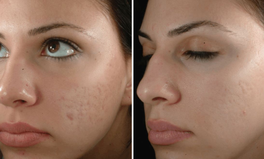 How much does scar removal cost in Arizona?